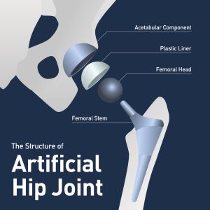 Artificial Hip Joint