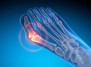 Cartiva implant failure